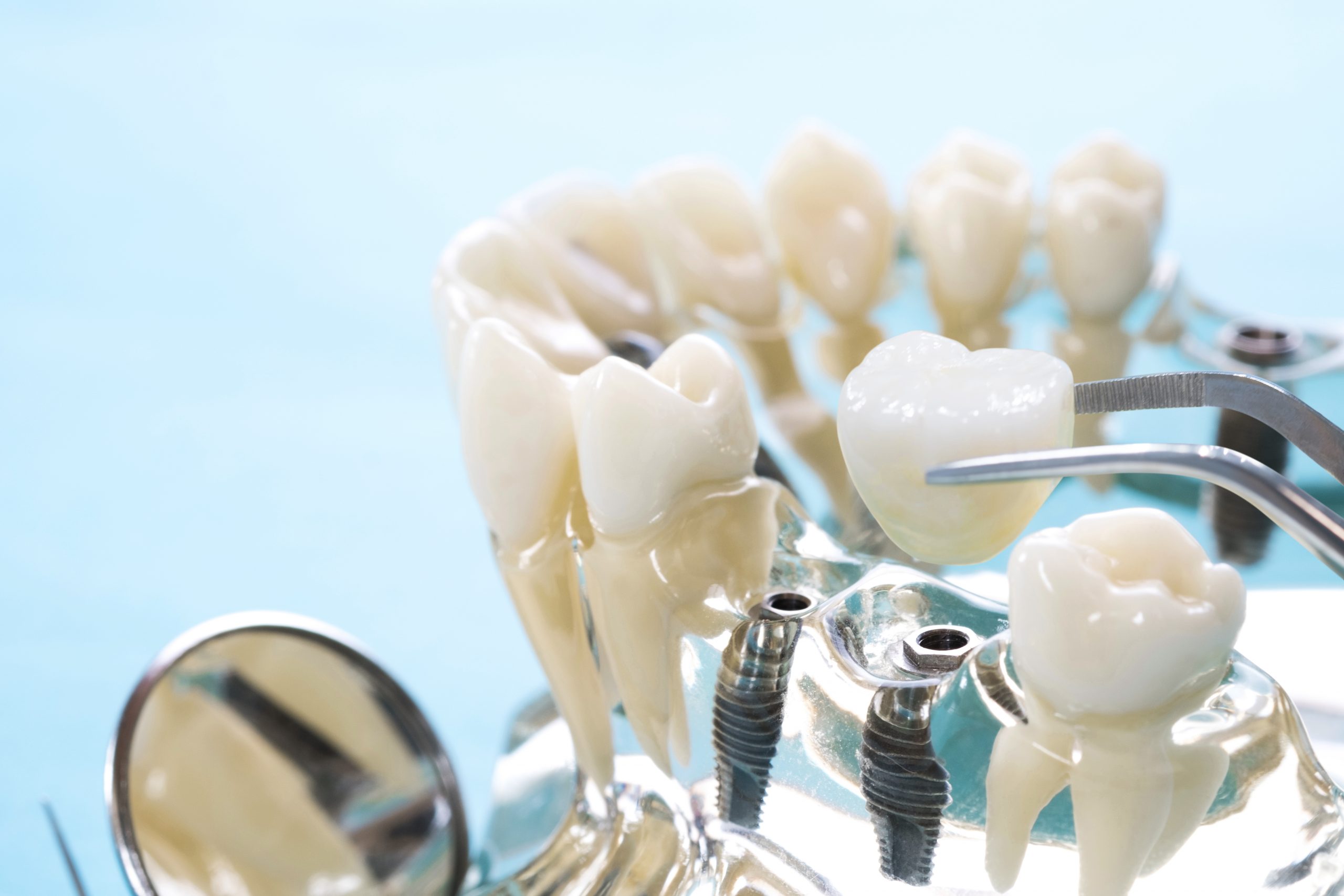 cabinet pentru implanturi dentare Ploiesti